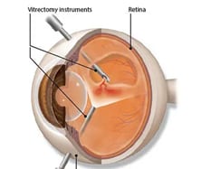 Vitreoretinal Surgery Maroochydore